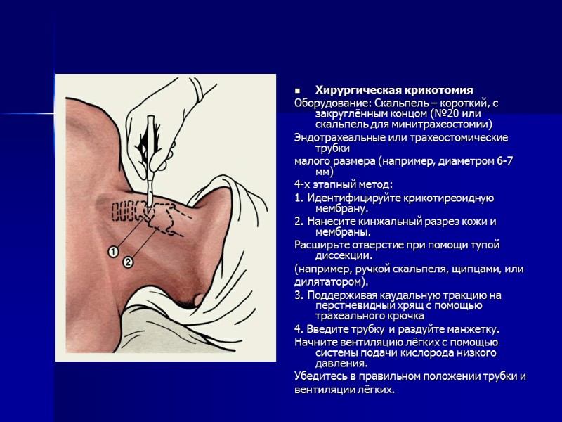 Хирургическая крикотомия Оборудование: Скальпель – короткий, с закруглённым концом (№20 или скальпель для минитрахеостомии)